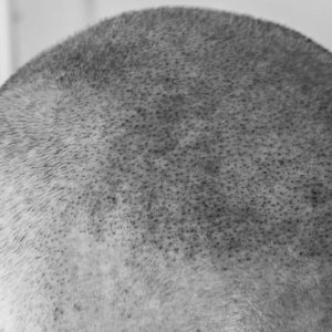 Third treatment of scalp micropigmentation blending style