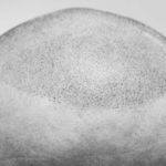 Image of a hair line created using Scalp Micropigmentation