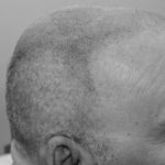 Image of Scalp Micropigmentation after one treatment of the side of the head