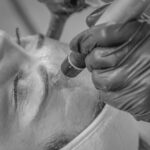 Male receiving skin needling on forehead